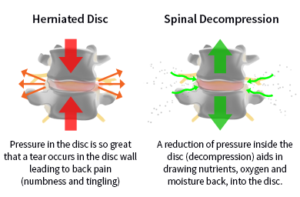 comparing a healthy and unhealthy spinal disc