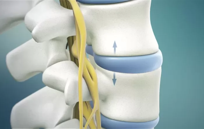 Spinal Decompression Treatment for Lasting Relief: A Complete Guide | HealthWorks Medical