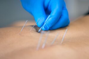 Dry Needling: Targeted Relief for Muscle Pain and Restored Mobility