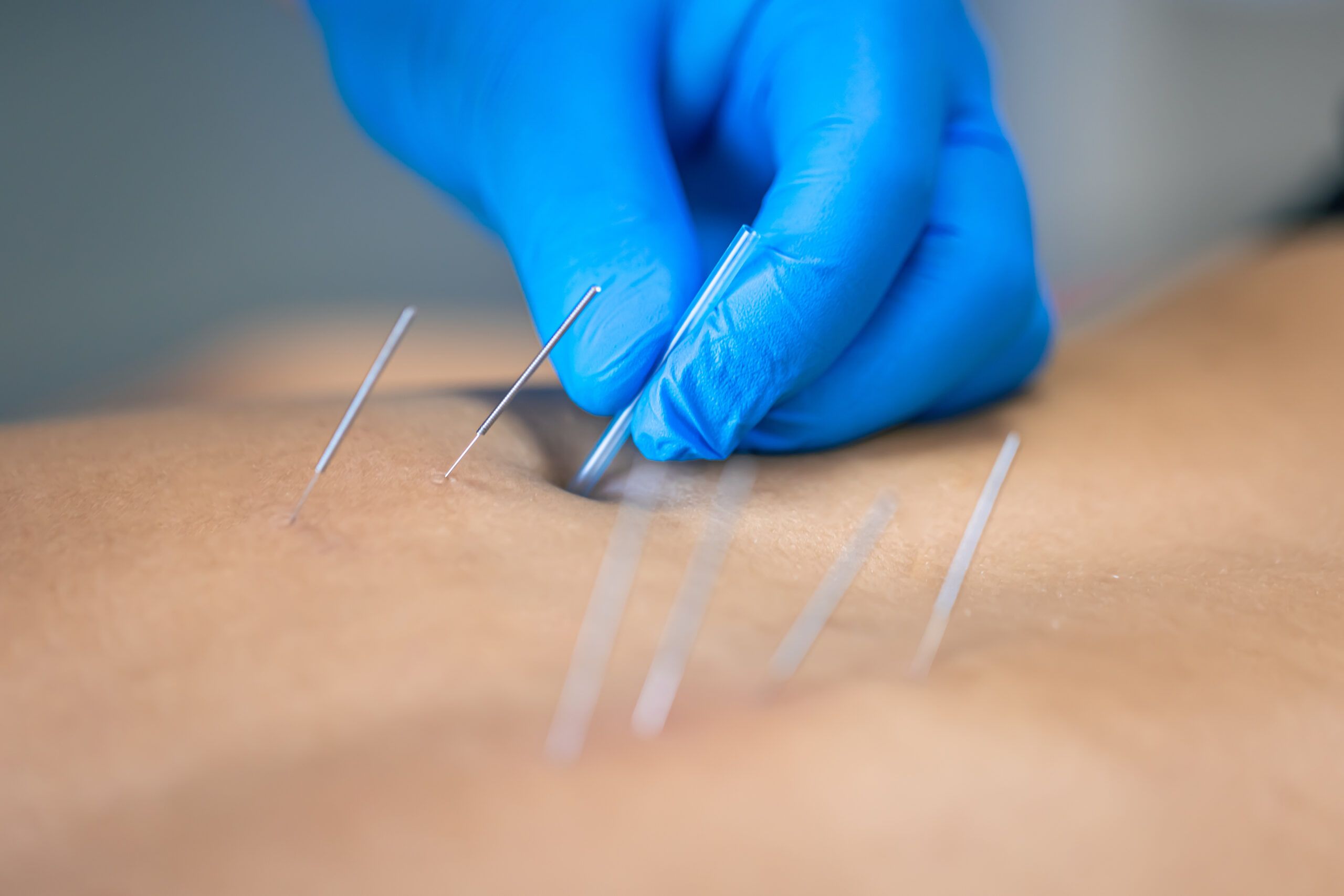 Dry Needling: Targeted Relief for Muscle Pain and Restored Mobility