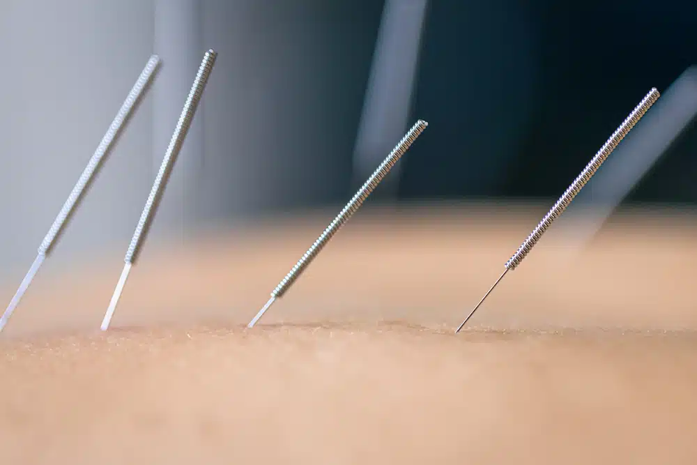 Trigger Points and Beyond: How Dry Needling Supports Faster Muscle Recovery