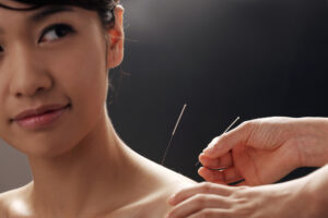 Precision Recovery: Unlocking Muscle Relief Through Dry Needling Techniques