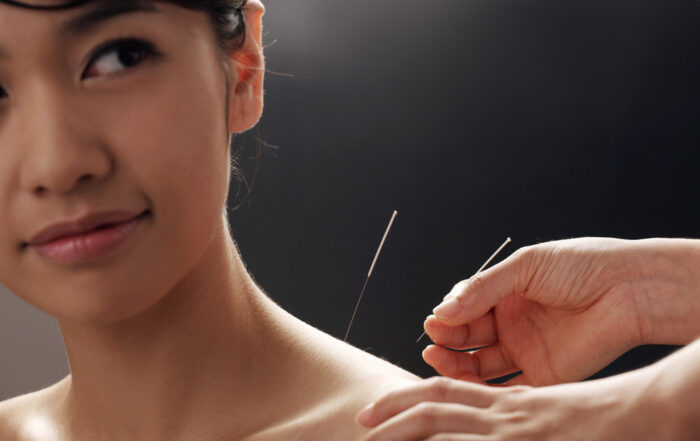 Precision Recovery: Unlocking Muscle Relief Through Dry Needling Techniques