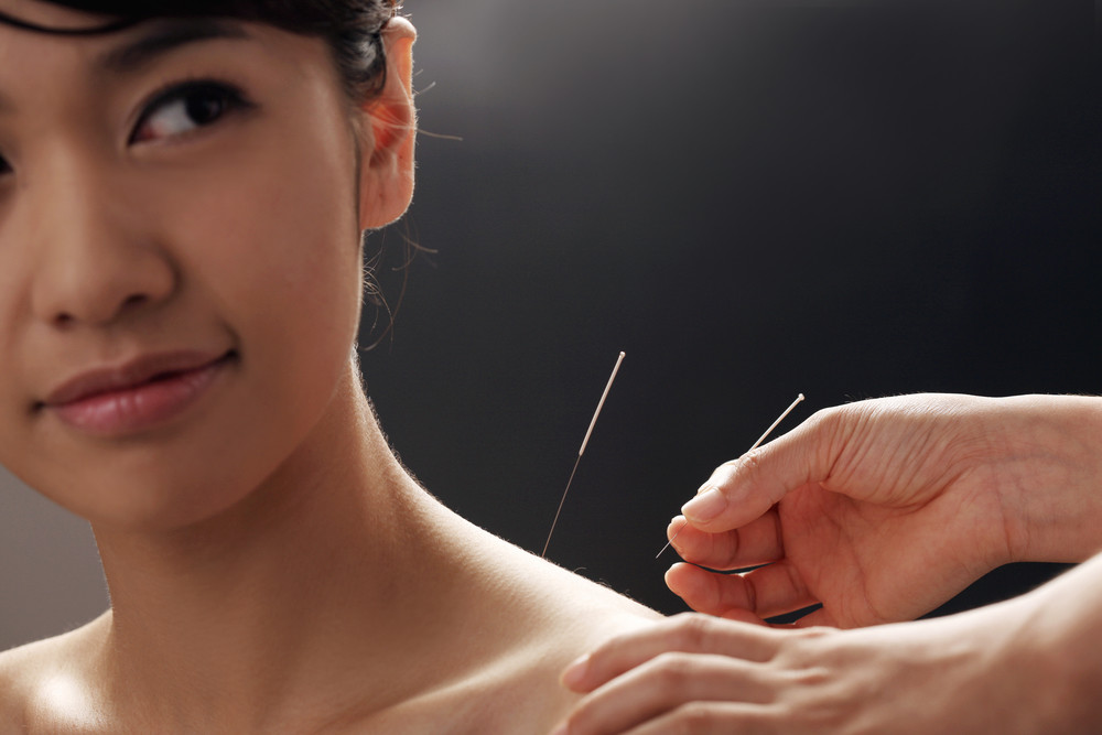 Precision Recovery: Unlocking Muscle Relief Through Dry Needling Techniques